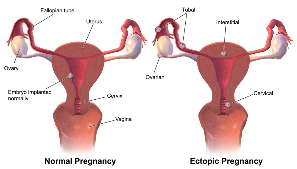 Ectopic Pregnancy by Bruce Blaus 