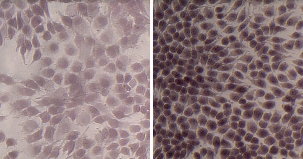 Before and after: the darker nodules in the second image show the ageing in bone cancer cells after treatment