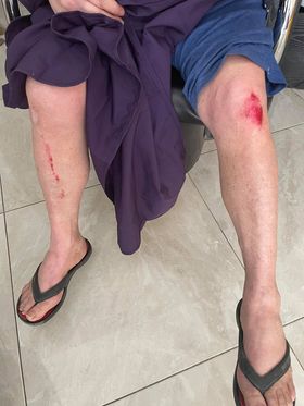 The woman's knees following her fall on the street