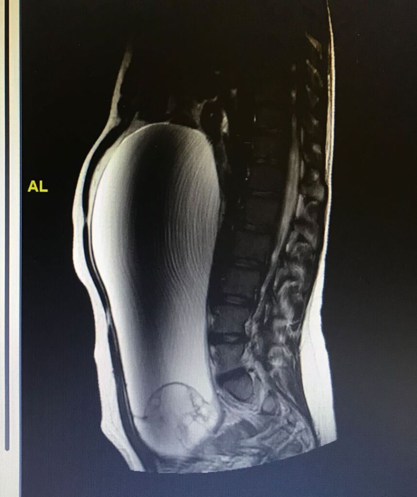 The ovarian cyst