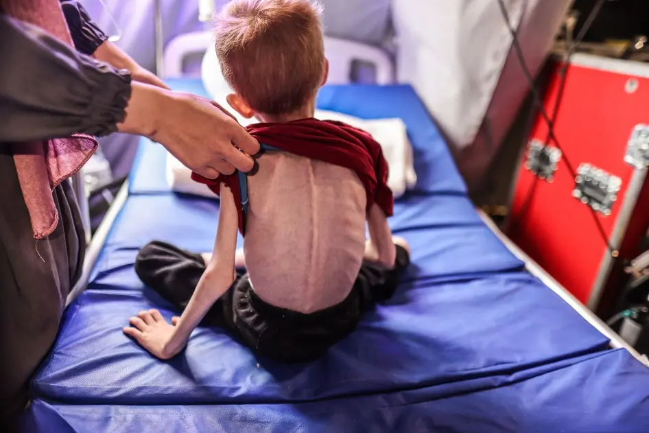 Malnourished child in Gaza. Ali Jadallah/Anadolu via Getty Images